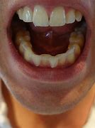 Image result for White Teeth Whitening