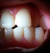 Image result for Small Teeth