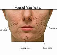 Image result for Do Acne Scars Go Away