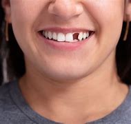 Image result for Front Tooth Flipper