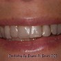 Image result for Flipper Anterior Tooth