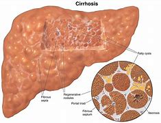 Image result for What Is Liver Cirrhosis