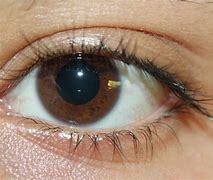 Image result for Crusty Eyes