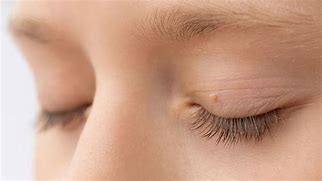 Image result for Removing Skin Tags On Eyelid