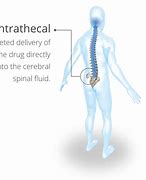 Image result for Intrathecal Injection