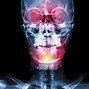 Image result for Goldenhar Syndrome Treatments Jaw