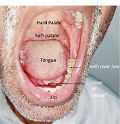 Image result for Early Signs of Tongue Cancer