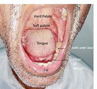 Image result for Tongue Cancer Early Signs