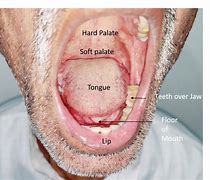 Image result for Stage 4 Mouth Cancer
