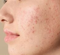 Image result for Pictures of Blemishes