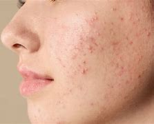 Image result for How to Remove Blemishes
