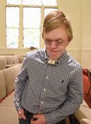 Image result for Famous People with Pfeiffer Syndrome
