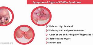 Image result for Pfeiffer Syndrome Symptoms