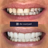 Image result for Dental Veneers Before After
