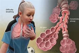 Image result for Adult Asthma Disease