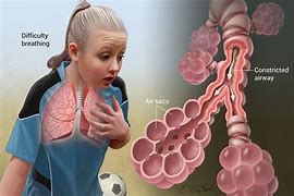 Image result for Acute Severe Asthma X-ray