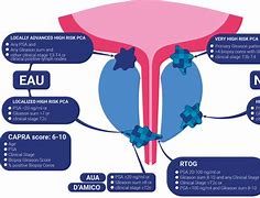 Image result for Stage 4 Prostate Cancer Symptoms