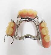 Image result for Metal Upper Partial Denture