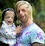 Image result for Treacher Collins Syndrome Before and After