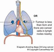 Image result for Stages of Cancer Lymph Node