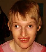 Image result for Angelman Syndrome Symptoms