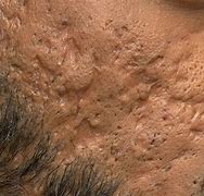 Image result for Cystic Acne Scars
