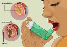 Image result for Asthma Phlegm