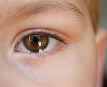 Image result for Scratched Cornea Treatment