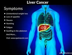 Image result for Stage Four Lung Cancer Prognosis
