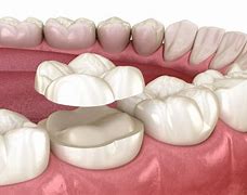 Image result for Dental Restoration