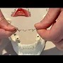 Image result for Orthodontic Removeable Appliance