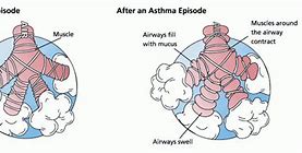 Image result for Child Asthma