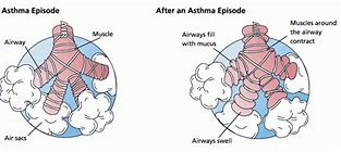 Image result for Asthma Patient