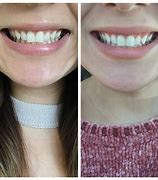 Image result for Dentist Teeth Whitening Before and After