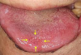 Image result for Stage 4 Tongue Cancer