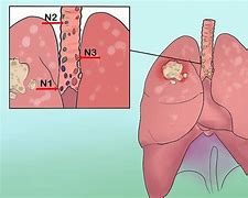 Image result for Lung Cancer Stage 4 Brain