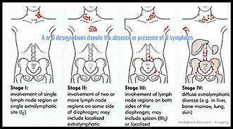 Image result for Stage 4 Cancer Lymph Nodes