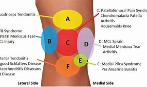Image result for Knee Anatomy Pain Chart