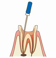 歯科　　根治　　難  イラスト に対する画像結果