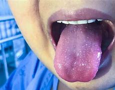 Image result for Kawasaki Disease Strawberry Tongue