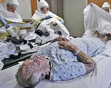 Image result for Smallpox