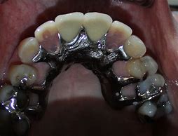 Image result for Metal Upper Partial Denture
