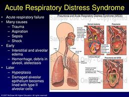 Image result for Acute Respiratory Distress Syndrome