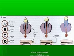Image result for Embryology Hypospadias