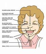 Image result for Angelman Syndrome