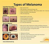 Image result for Malignant Melanoma Stages