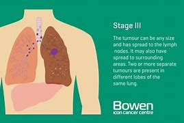 Image result for Lung Cancer Stage 4 Progression