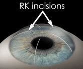 Image result for rk surgery