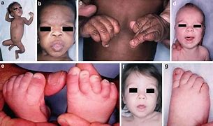 Image result for Fetal Drug Syndrome Facial Features