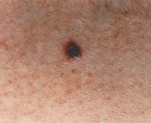 Image result for Stages of Non Melanoma Skin Cancer